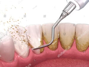 diş taşı temizliği